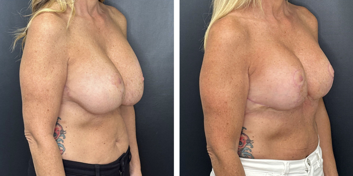 before and after breast implant exchange and breast lift right angled view case 1360