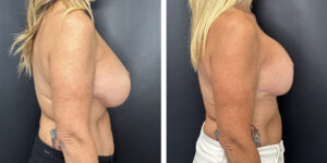 before and after breast implant exchange and breast lift right side view case 1360