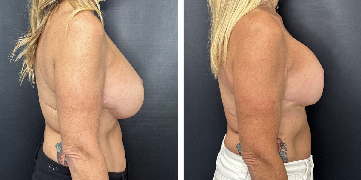 before and after breast implant exchange and breast lift right side view case 1360