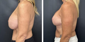 before and after breast implant exchange and breast lift left side view case 1360