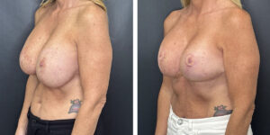 before and after breast implant exchange and breast lift left angled view case 1360