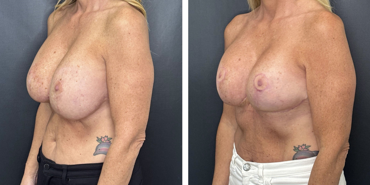 before and after breast implant exchange and breast lift left angled view case 1360