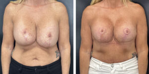 before and after breast implant exchange and breast lift front view case 1360
