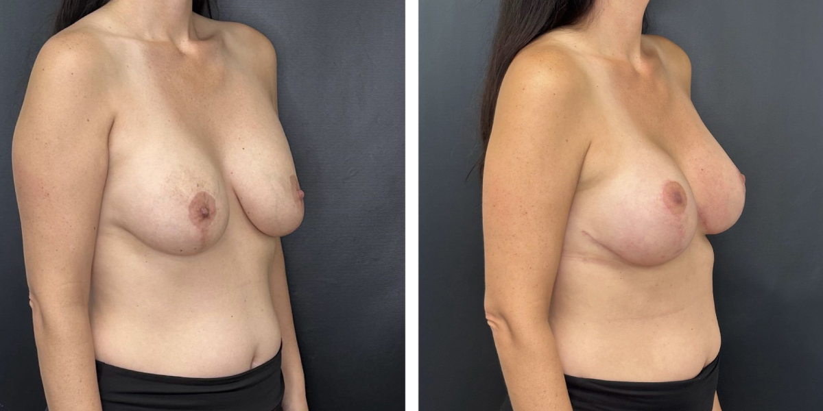 before and after breast implant exchange and breast lift right angled view case 1366