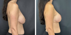 before and after breast implant exchange and breast lift right side view case 1366