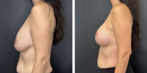 before and after breast implant exchange and breast lift left side view case 1366