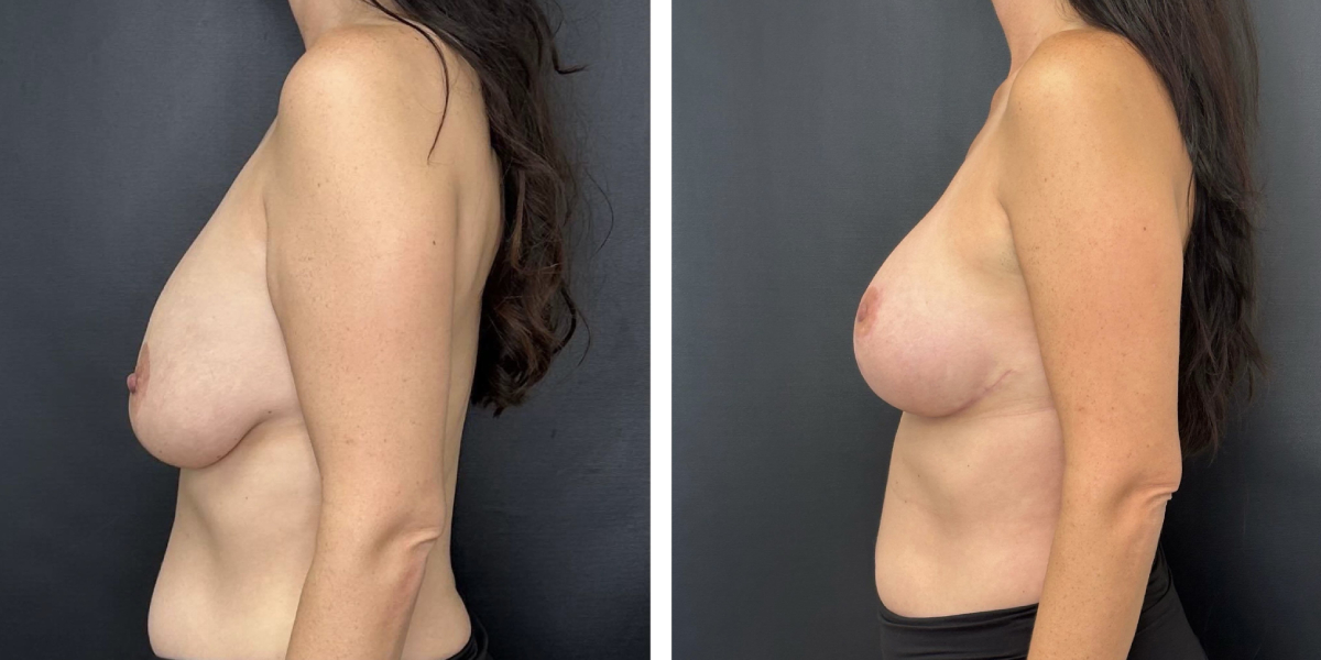 before and after breast implant exchange and breast lift left side view case 1366