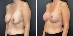 before and after breast implant exchange and breast lift left angled view case 1366