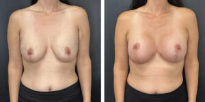 before and after breast implant exchange and breast lift front view case 1366