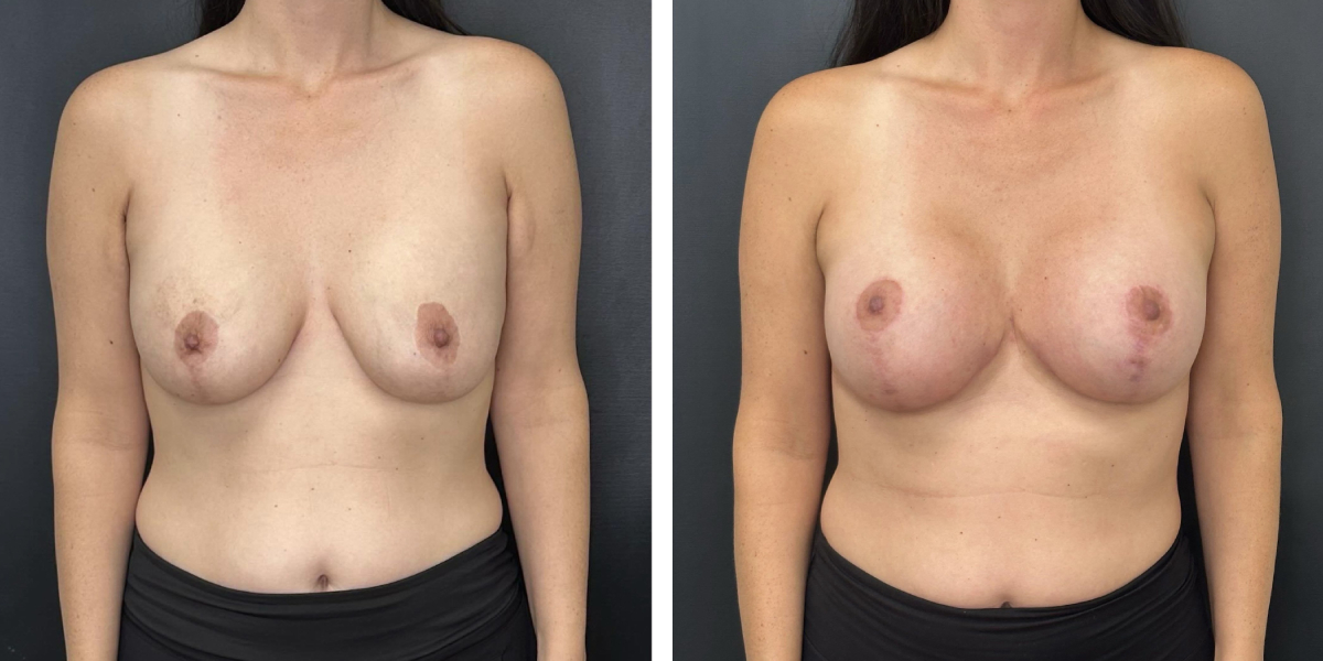 before and after breast implant exchange and breast lift front view case 1366