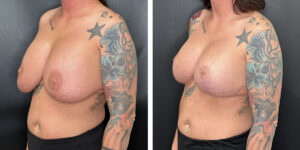 before and after breast implant exchange and breast lift left angled view case 1372