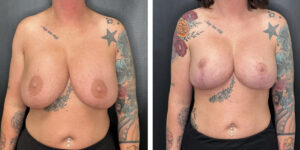 before and after breast implant exchange and breast lift front view case 1372