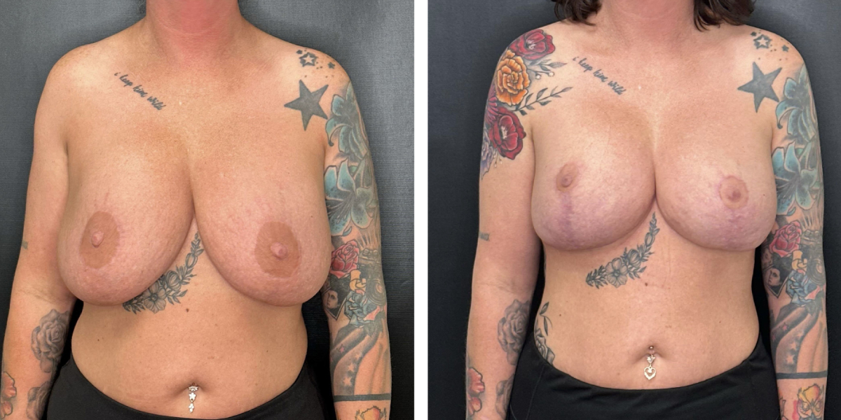 before and after breast implant exchange and breast lift front view case 1372