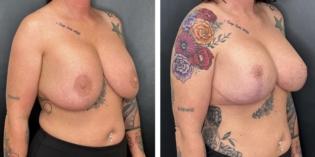 before and after breast implant exchange and breast lift right angled view case 1372