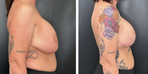 before and after breast implant exchange and breast lift right side view case 1372