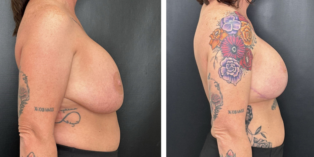 before and after breast implant exchange and breast lift right side view case 1372