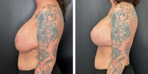before and after breast implant exchange and breast lift left side view case 1372