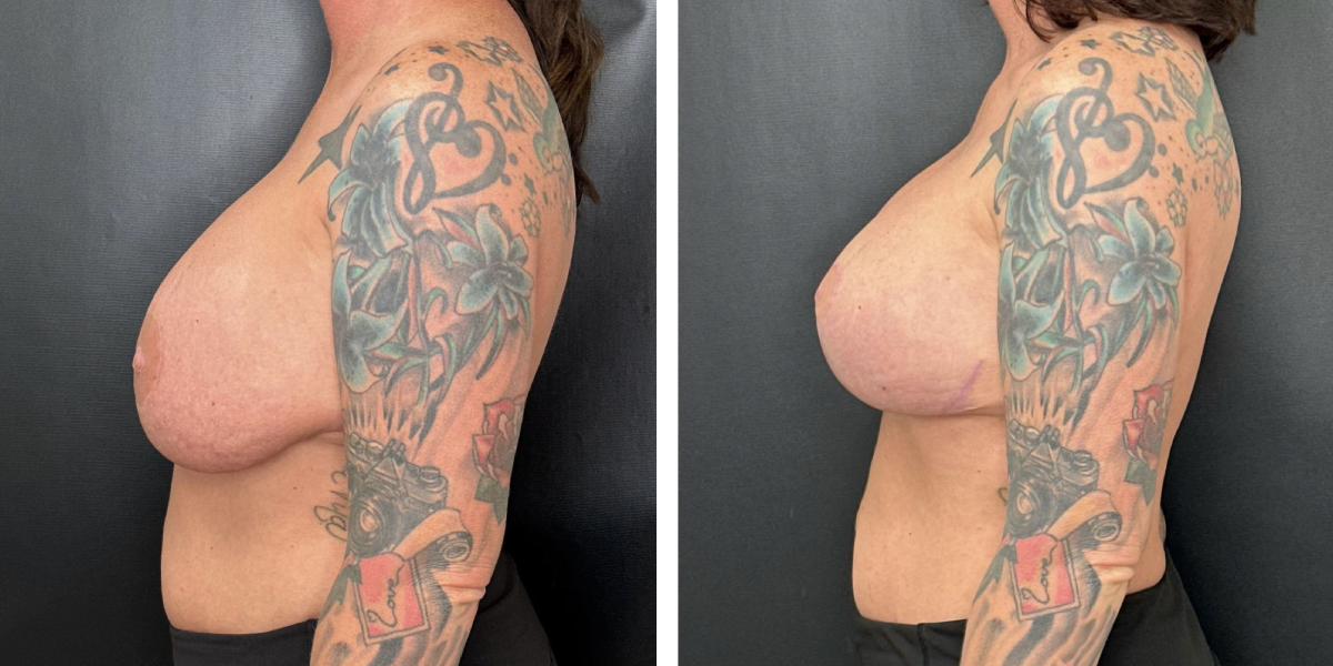 before and after breast implant exchange and breast lift left side view case 1372
