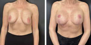 before and after breast implant exchange and breast lift front view case 1379