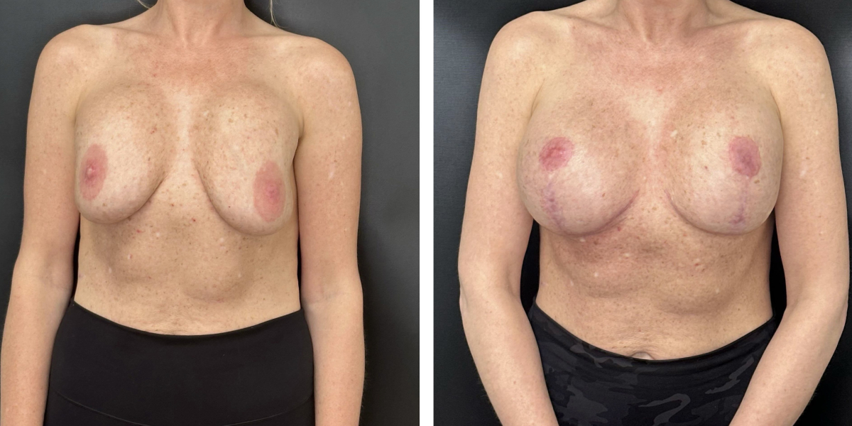 before and after breast implant exchange and breast lift front view case 1379