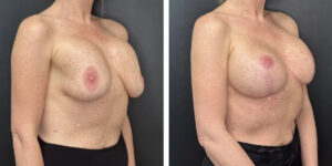 before and after breast implant exchange and breast lift right angled view case 1379