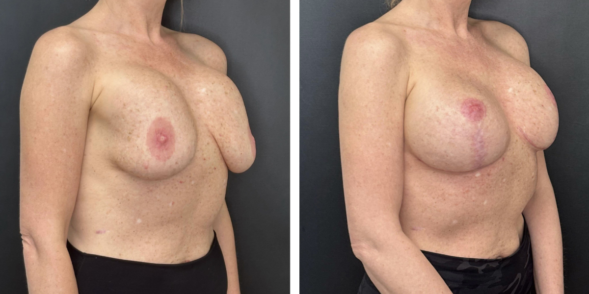 before and after breast implant exchange and breast lift right angled view case 1379