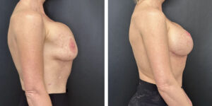 before and after breast implant exchange and breast lift right side view case 1379