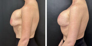 before and after breast implant exchange and breast lift left side view case 1379