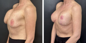before and after breast implant exchange and breast lift left angled view case 1379