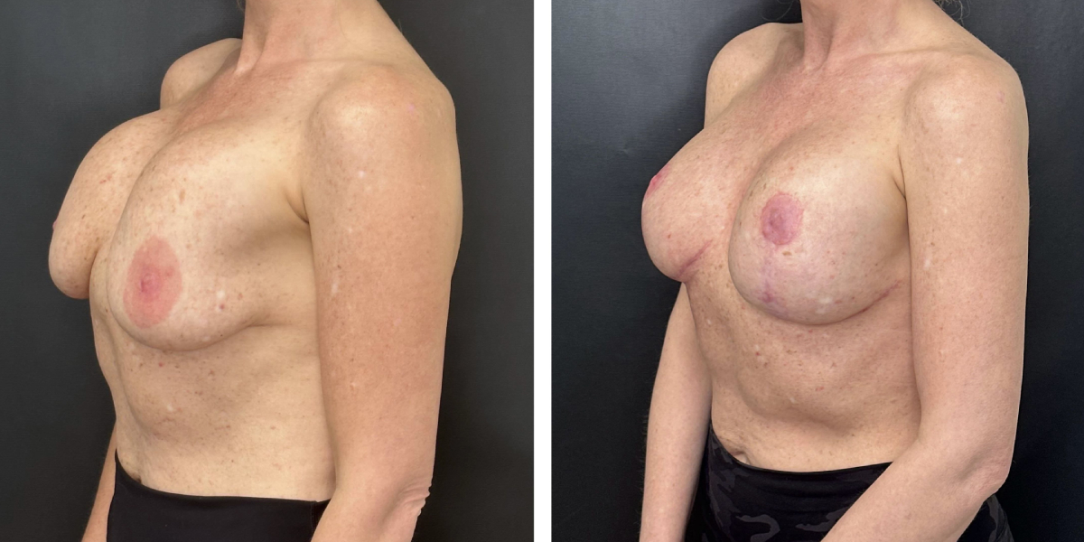 before and after breast implant exchange and breast lift left angled view case 1379