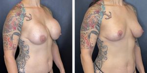 before and after breast lift right angled view case 1311