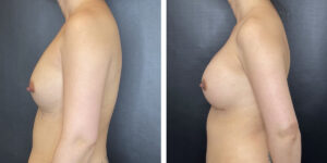 before and after breast implant revision left side view case 1386