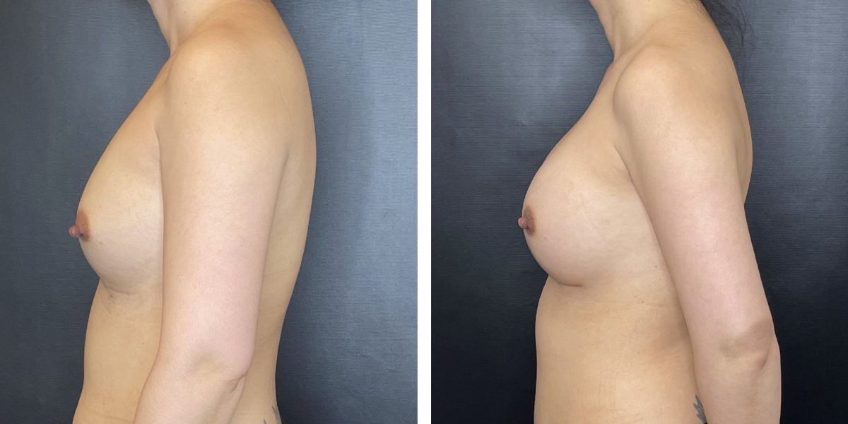 before and after breast implant revision left side view case 1386