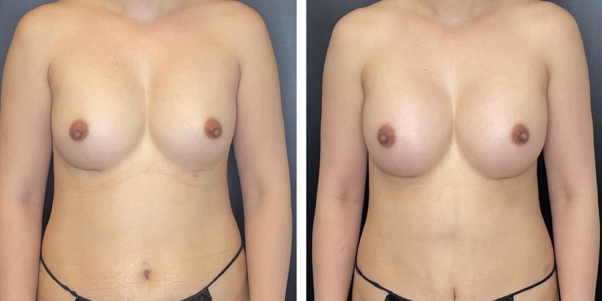 before and after breast implant revision front view case 1386