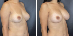 before and after breast implant revision right angled view case 1392