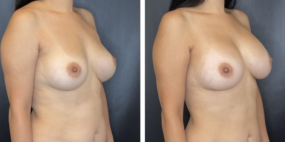before and after breast implant revision right angled view case 1392