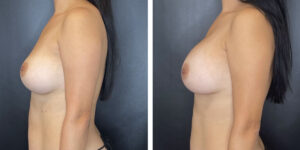 before and after breast implant revision left side view case 1392