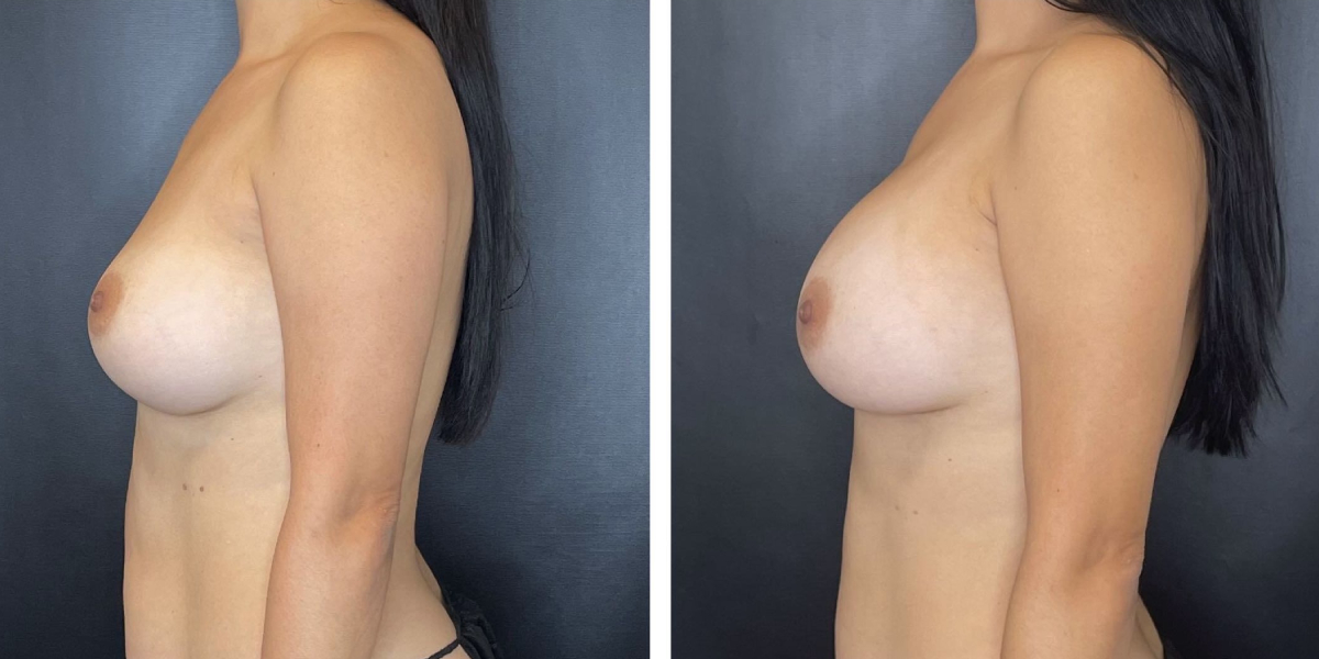 before and after breast implant revision left side view case 1392
