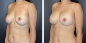 before and after breast implant revision left angled view case 1392