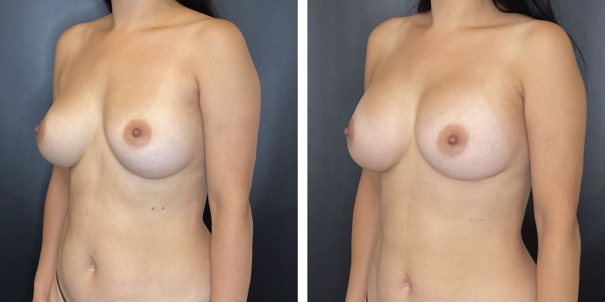 before and after breast implant revision left angled view case 1392