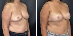 before and after breast implant revision left angled view case 1398