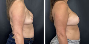 before and after breast implant revision right side view case 1398