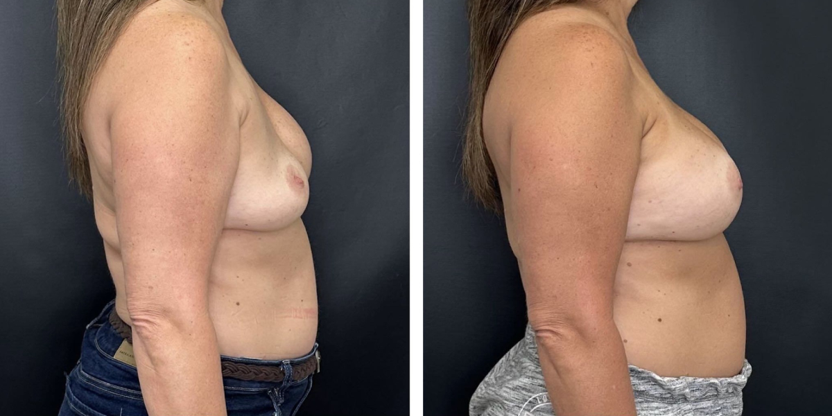 before and after breast implant revision right side view case 1398