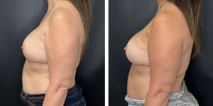 before and after breast implant revision left side view case 1398