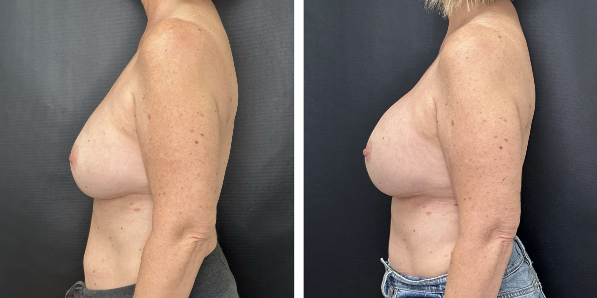 before and after breast implant revision left side view case 1404