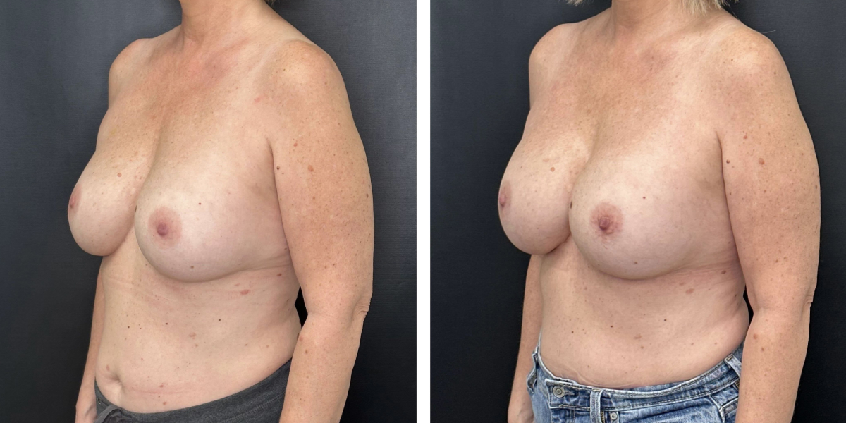 before and after breast implant revision left angled view case 1404