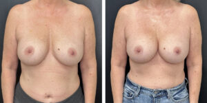 before and after breast implant revision front view case 1404