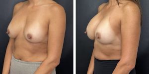 before and after breast implant revision left angled view case 1410