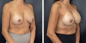 before and after breast implant revision right angled view case 1410