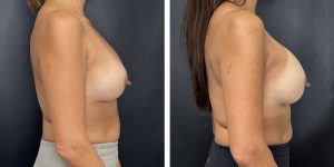 before and after breast implant revision right side view case 1410